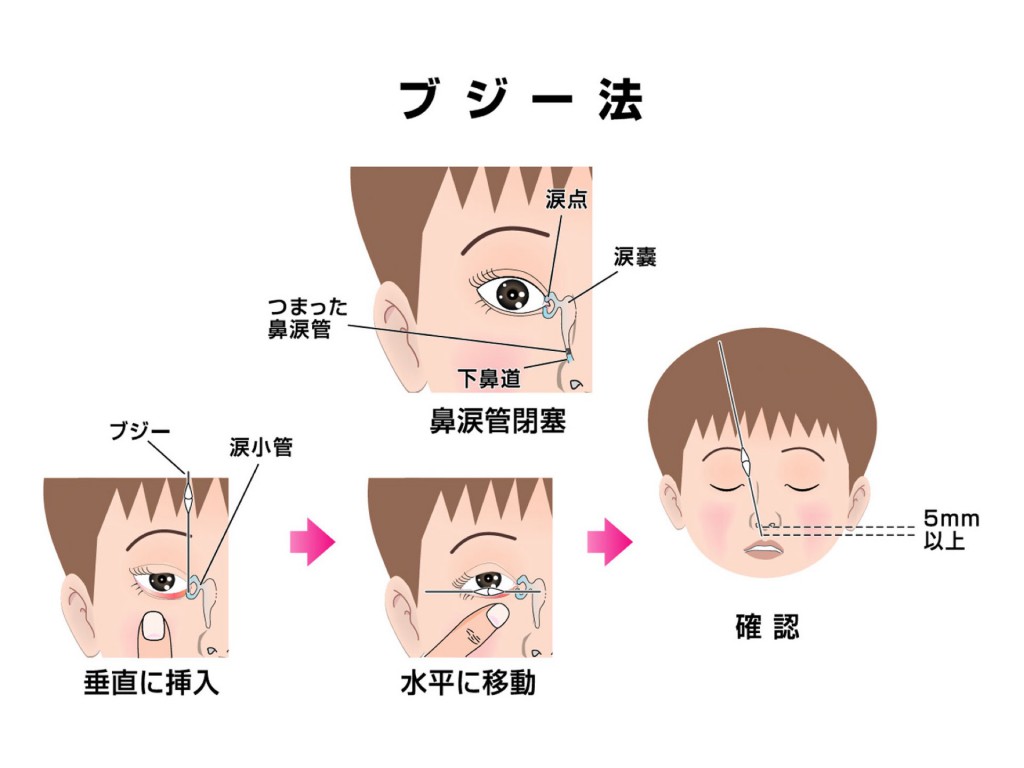 ブジー と は 看護